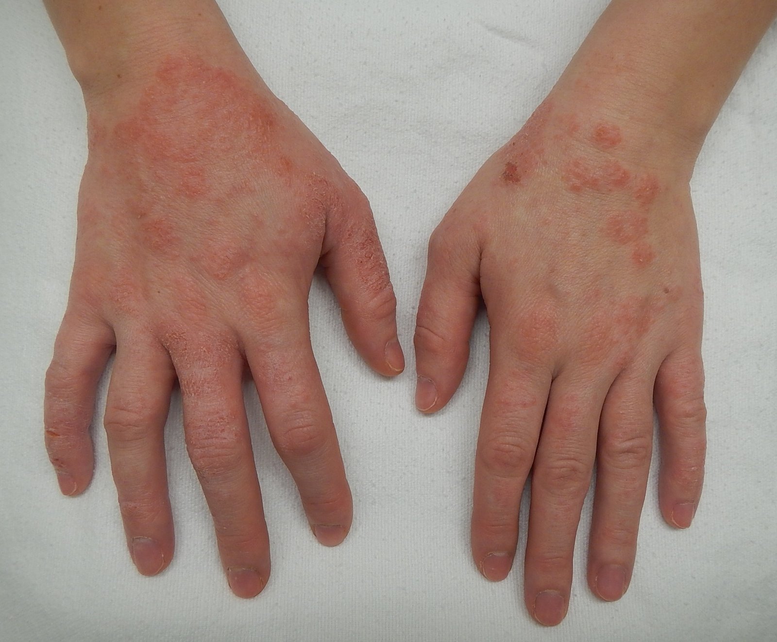 Dermatitis - Dr Shubham Singh