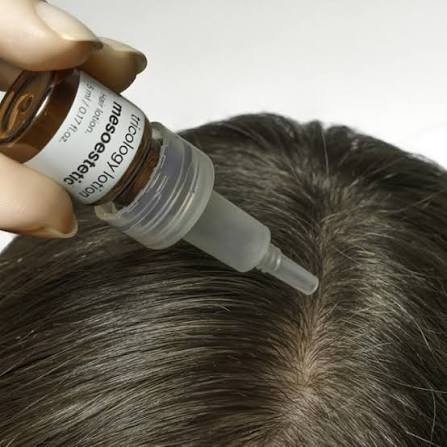 Hair mesotherapy - Dr Shubham Singh