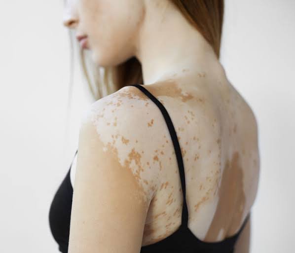 Vitiligo - Dr Shubham Singh