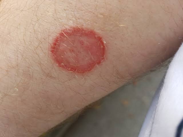 fungal skin infection 1 - Dr Shubham Singh