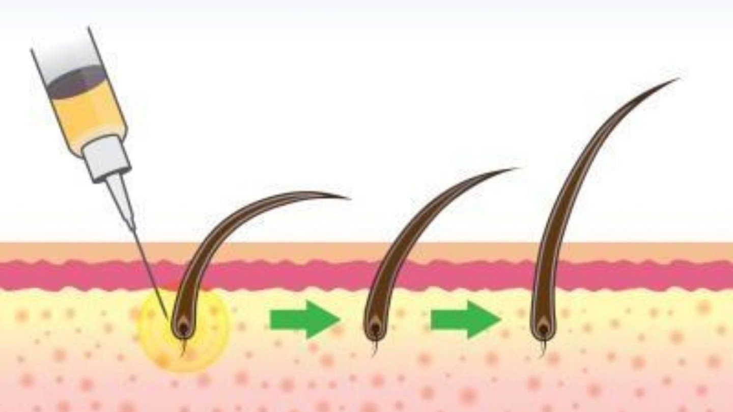 mesotherapy - Dr Shubham Singh