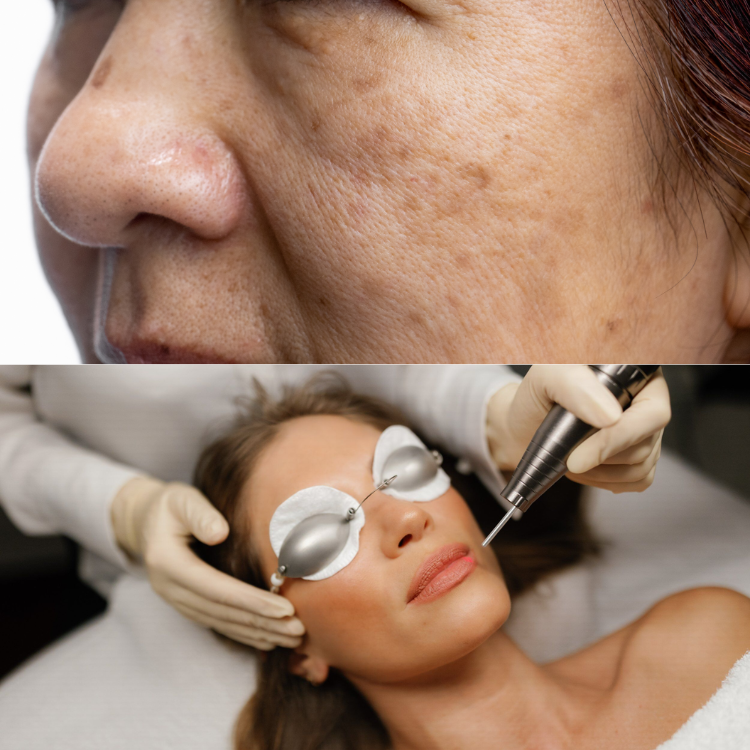 pigmentation and treatment - Dr Shubham Singh