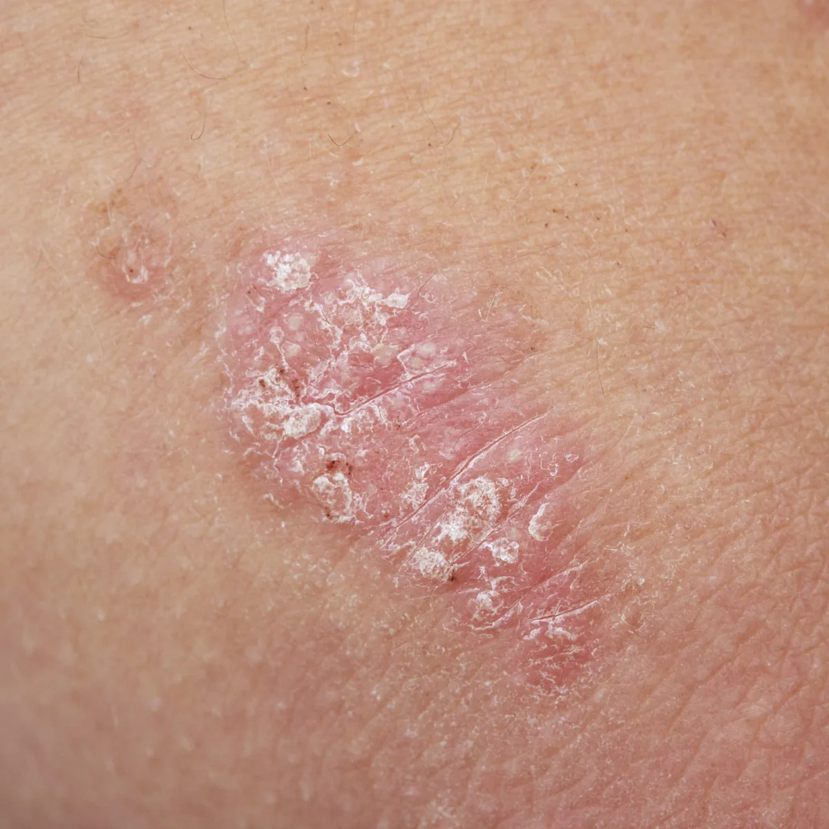 psoriasis - Dr Shubham Singh