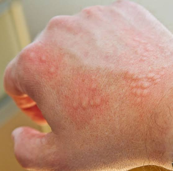 skin allergies - Dr Shubham Singh