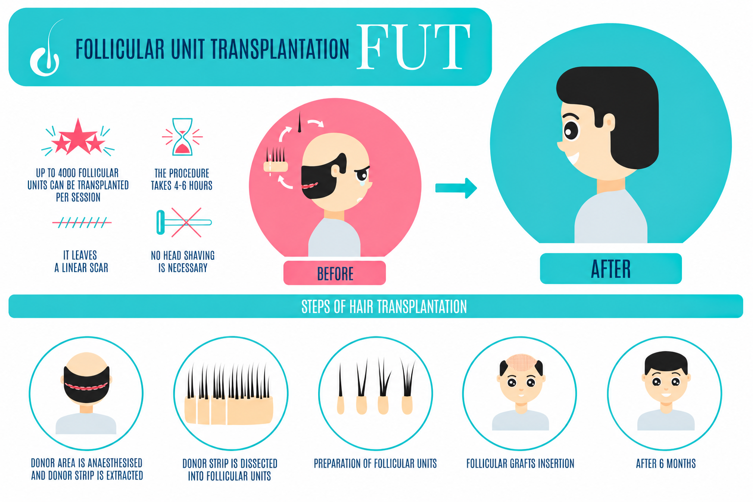 Follicular Unit Transplantation Infographic - Dr Shubham Singh